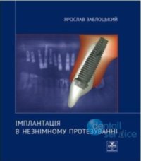 Імплантація в незнімному протезуванні