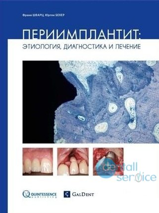 Периимплантит: этиология, диагностика и лечение