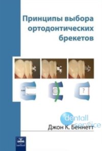 Принципы выбора ортодонтических брекетов