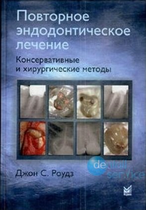 Повторное эндодонтическое лечение.