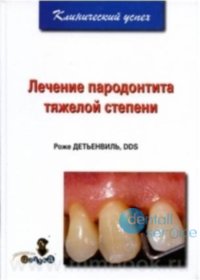 Лечение пародонтита тяжелой степени